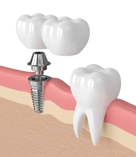 3D render implantu z dentystyczne mostu wspornikowego — Zdjęcie stockowe