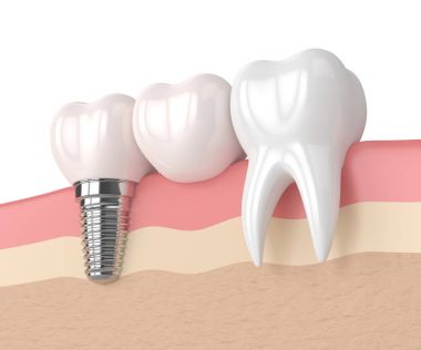 implant diş köprü prensibine göre ile 3D render 