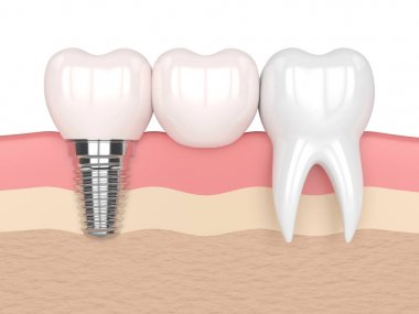 implant diş köprü prensibine göre ile 3D render 
