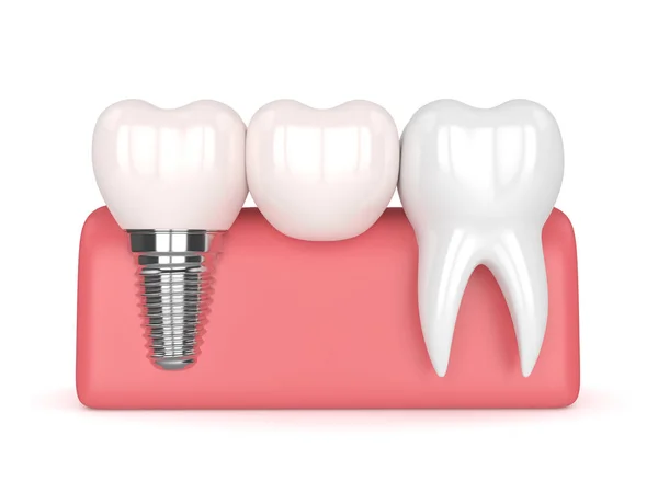 3D renderizado de implante con puente en voladizo dental — Foto de Stock