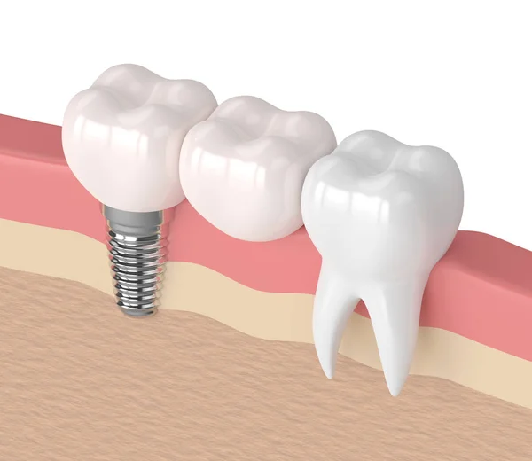 3D візуалізація імплантату з зубним консольним мостом — стокове фото