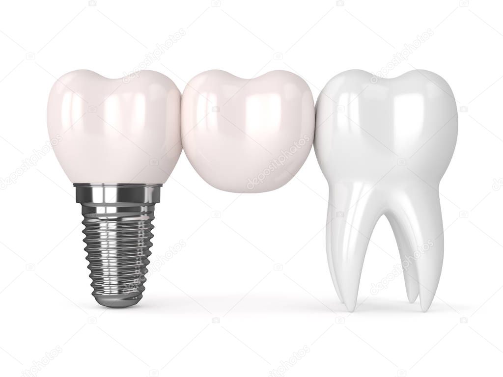 3d render of implant with dental cantilever bridge 