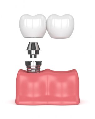 implant diş köprü prensibine göre ile 3D render 