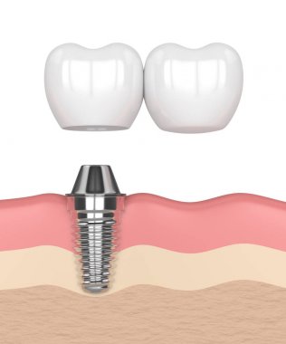 implant diş köprü prensibine göre ile 3D render 