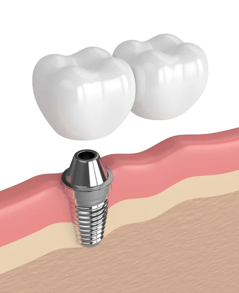 3D візуалізація імплантату з зубним консольним мостом — стокове фото