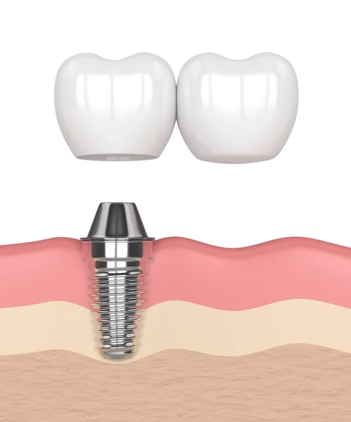 3D візуалізація імплантату з зубним консольним мостом — стокове фото