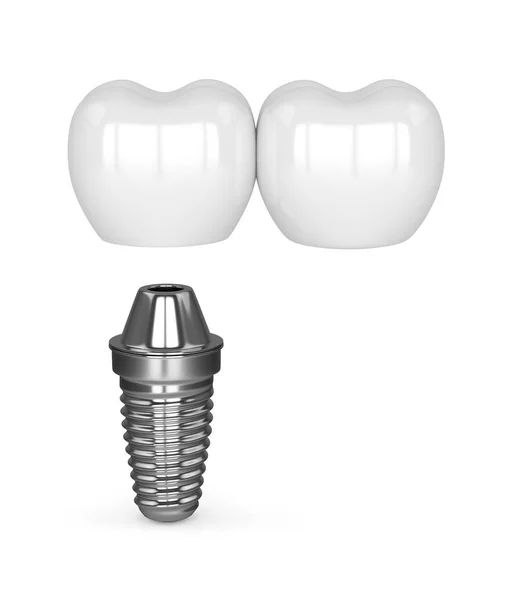 3D render implantu z dentystyczne mostu wspornikowego — Zdjęcie stockowe