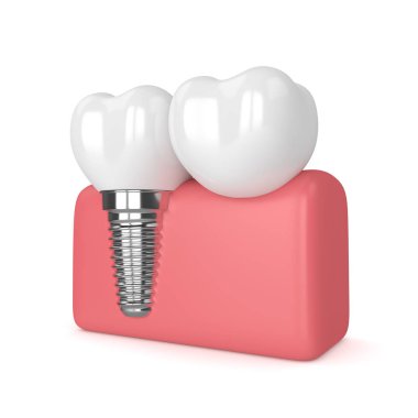 implant diş köprü prensibine göre ile 3D render 