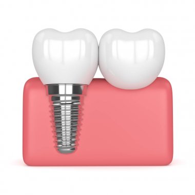 implant diş köprü prensibine göre ile 3D render 