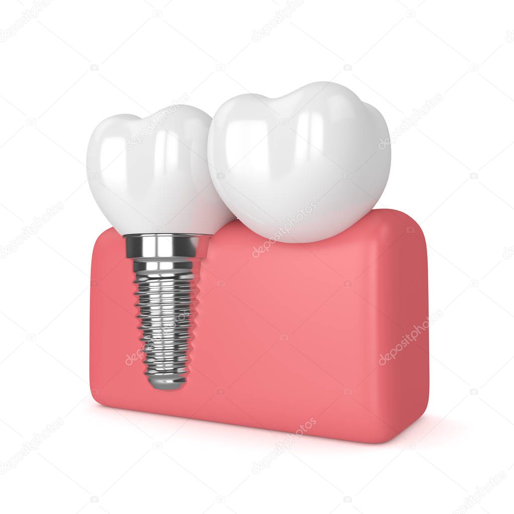 3d render of implant with dental cantilever bridge 