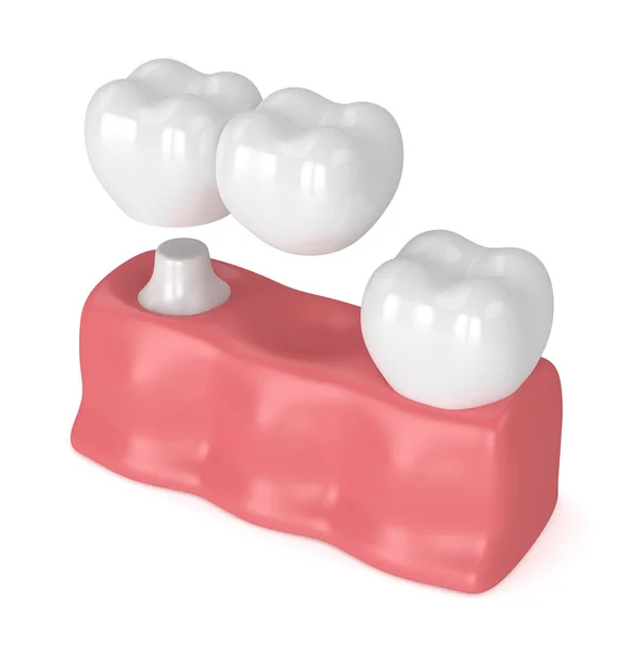 3D рендеринг зубов с помощью консольного моста — стоковое фото