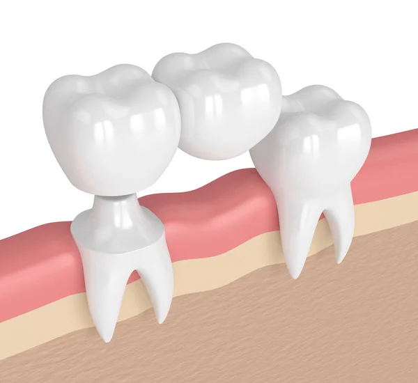 片持梁橋の歯科での歯の 3 d レンダリング — ストック写真