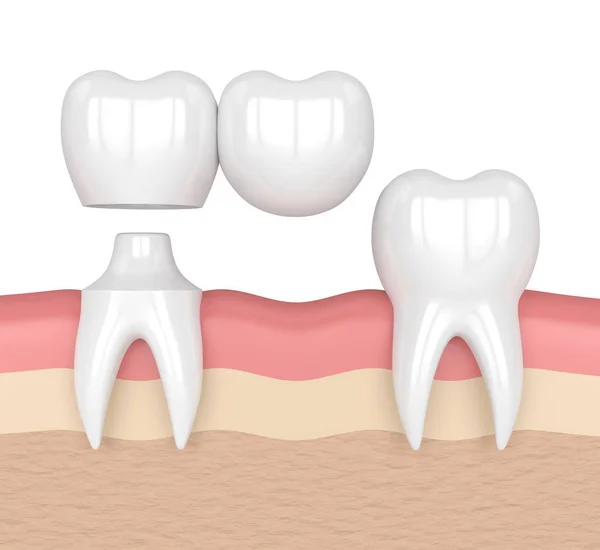 3d renderizado de dientes con puente voladizo dental — Foto de Stock