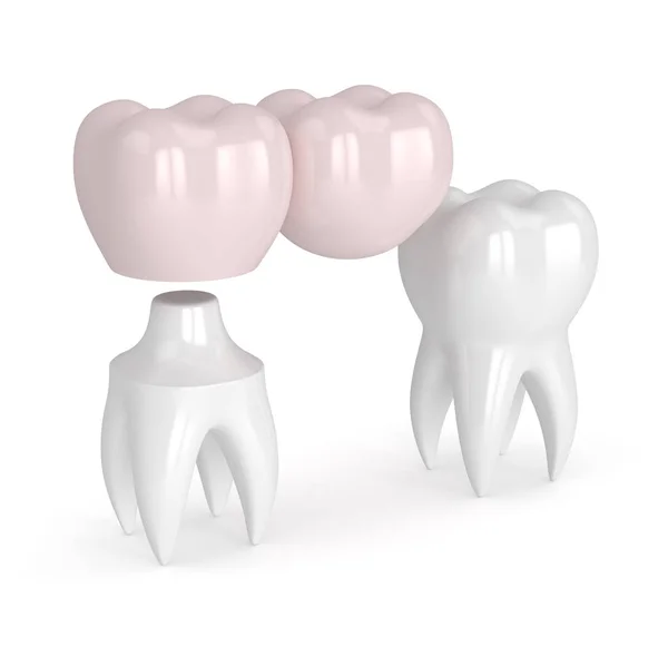3d rendering gigi dengan gigi kantilever jembatan — Stok Foto
