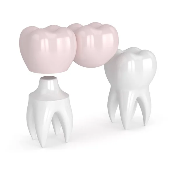 3d renderizado de dientes con puente voladizo dental — Foto de Stock