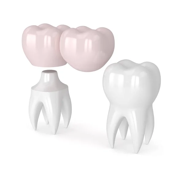 3D-Rendering der Zähne mit Zahnausleger-Brücke — Stockfoto