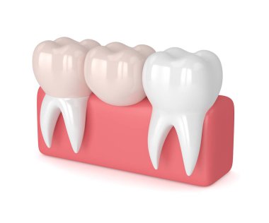 diş diş köprü prensibine göre ile 3D render 