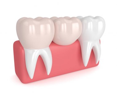 3d render of teeth with dental cantilever bridge  clipart