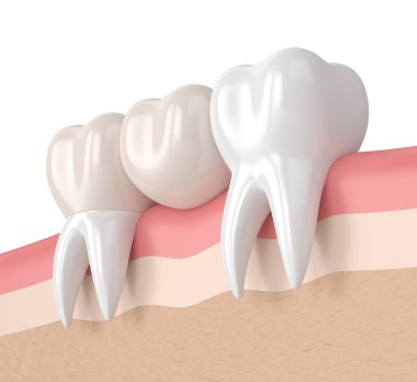 diş diş köprü prensibine göre ile 3D render 