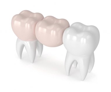 diş diş köprü prensibine göre ile 3D render 