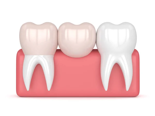 3d renderização de dentes com ponte cantilever dental — Fotografia de Stock