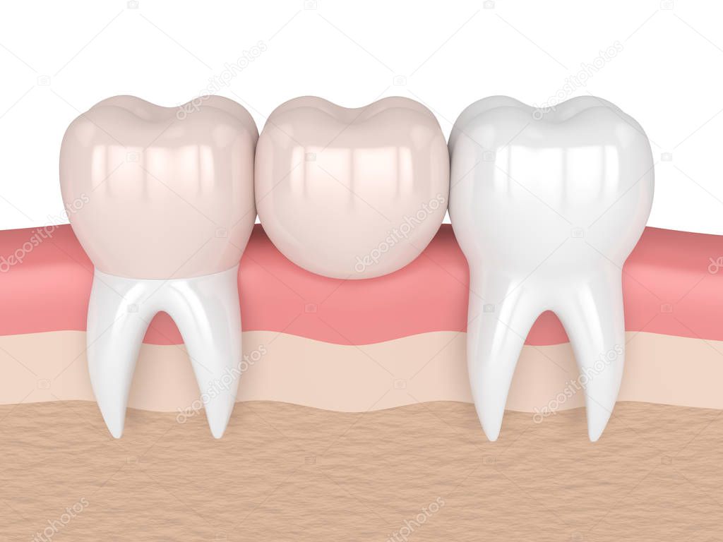 3d render of teeth with dental cantilever bridge 
