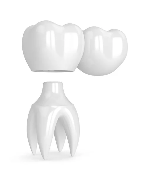 3D činí z zubů zubní konzolový most — Stock fotografie