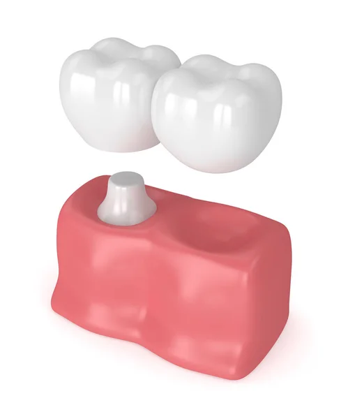 3d render of teeth with dental cantilever bridge — Stock Photo, Image
