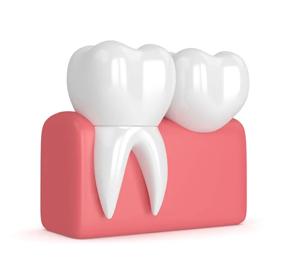 3d render of teeth with dental cantilever bridge — Stock Photo, Image