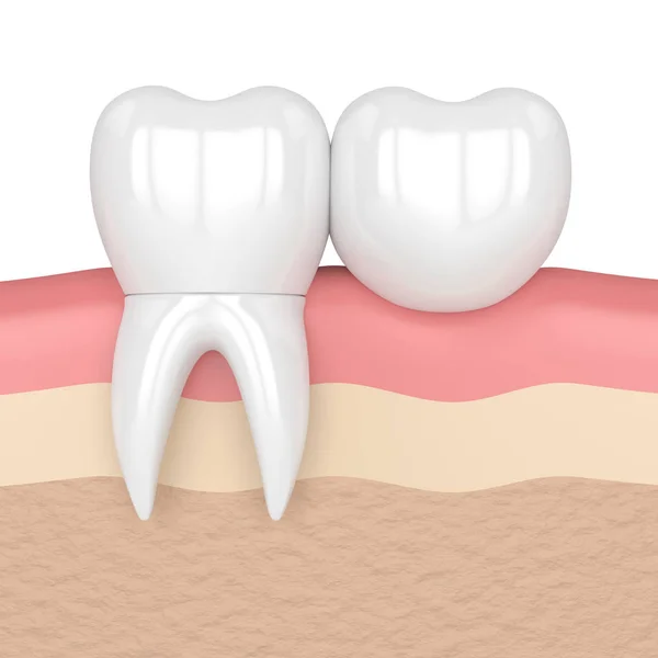 Diş diş köprü prensibine göre ile 3D render — Stok fotoğraf