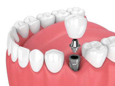 diş ve diş azıdişinde implant çene 3D render