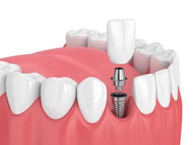 3d render of jaw with teeth and dental incisor implant clipart