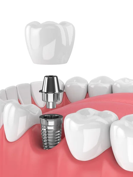 diş ve diş molar implant çene 3D render