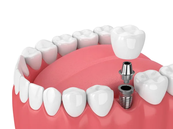 3d render of jaw with teeth and dental molar implant — Stock Photo, Image