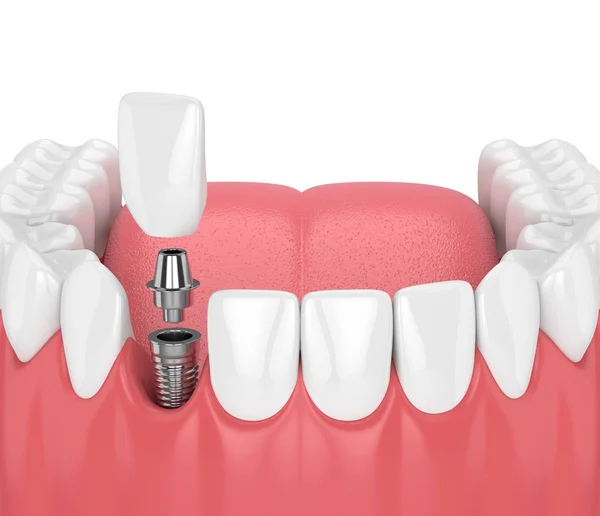 3D render szczęki z implantów dentystycznych siekaczy i zębów — Zdjęcie stockowe