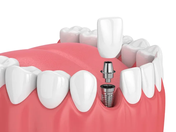 3D render állkapocs, fogak és fogászati metsző implantátum — Stock Fotó