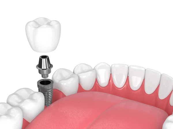 3D-Darstellung des Kiefers mit Zähnen und Backenzahn-Implantat lizenzfreie Stockfotos