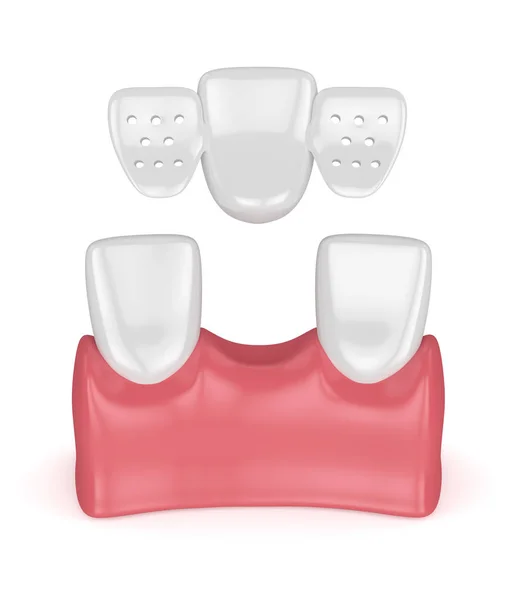 Odwzorowania 3D zębów dentystycznych most maryland — Zdjęcie stockowe