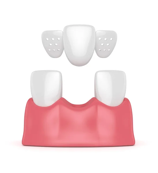 3d render of teeth with dental maryland bridge — Stock Photo, Image