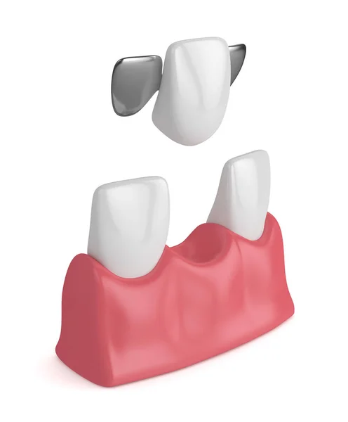 Odwzorowania 3D zębów dentystycznych most maryland — Zdjęcie stockowe