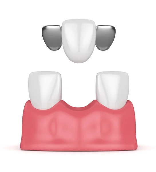 3d renderizado de dientes con puente maryland dental — Foto de Stock