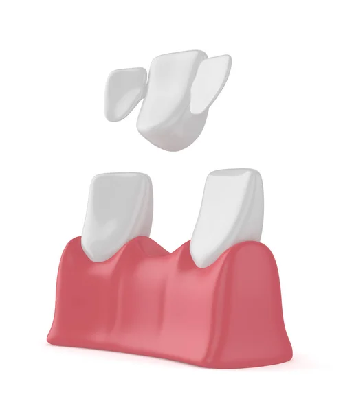 3d renderização de dentes com ponte maryland dental — Fotografia de Stock