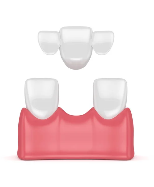 3d renderização de dentes com ponte maryland dental — Fotografia de Stock