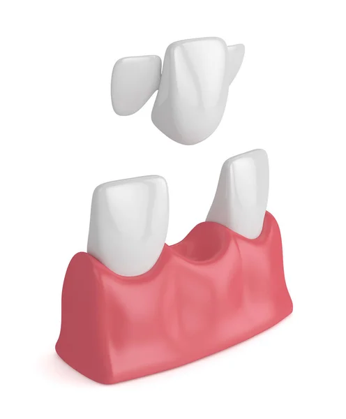 3d render of teeth with dental maryland bridge — Stock Photo, Image