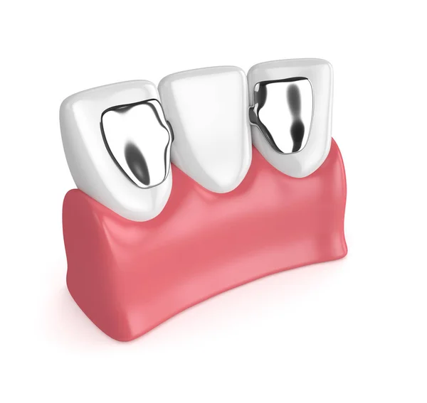 3d renderizado de dientes con puente maryland dental — Foto de Stock