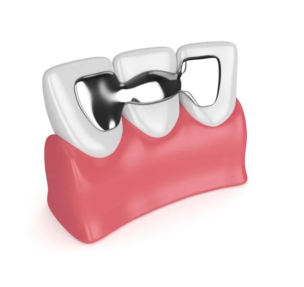 3D-Darstellung der Zähne mit Zahnmaryland-Brücke — Stockfoto