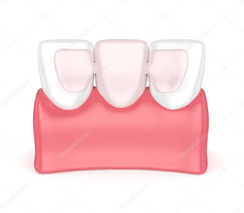 3d render of teeth with dental maryland bridge 