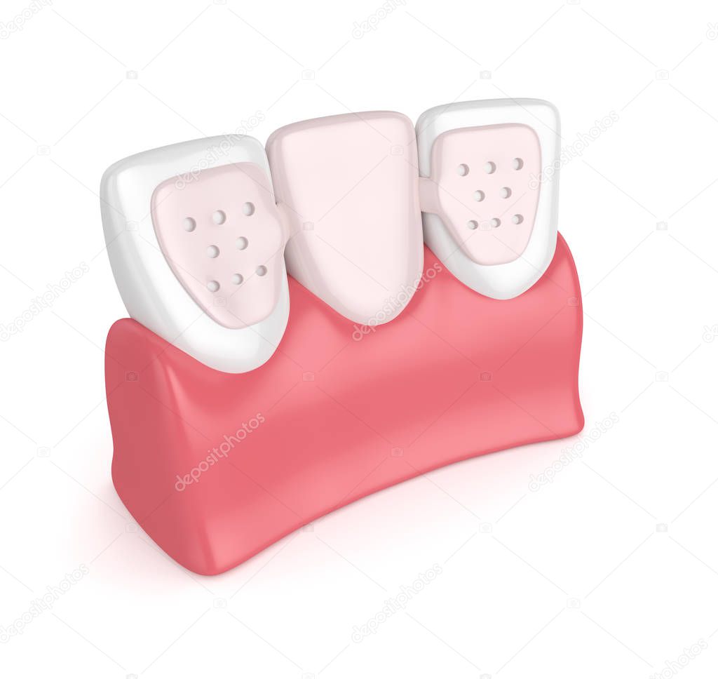 3d render of teeth with dental maryland bridge 