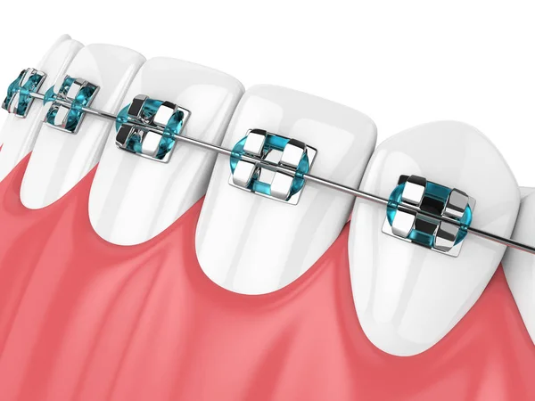 3D рендеринг челюсти с зубами и ортодонтическими брекетами — стоковое фото