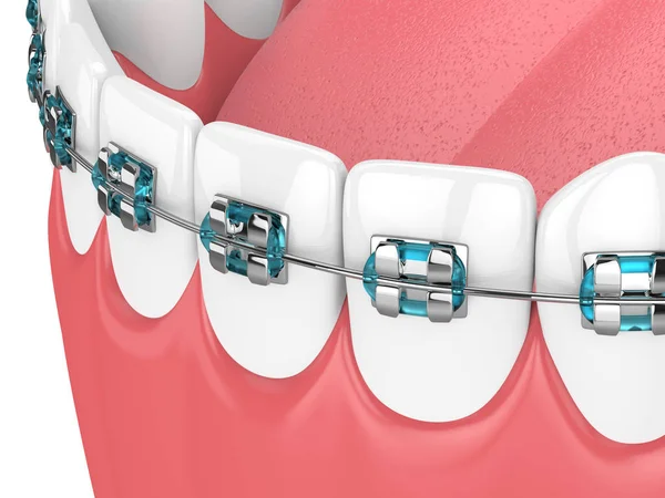 3d renderização da mandíbula com dentes e aparelho ortodôntico — Fotografia de Stock